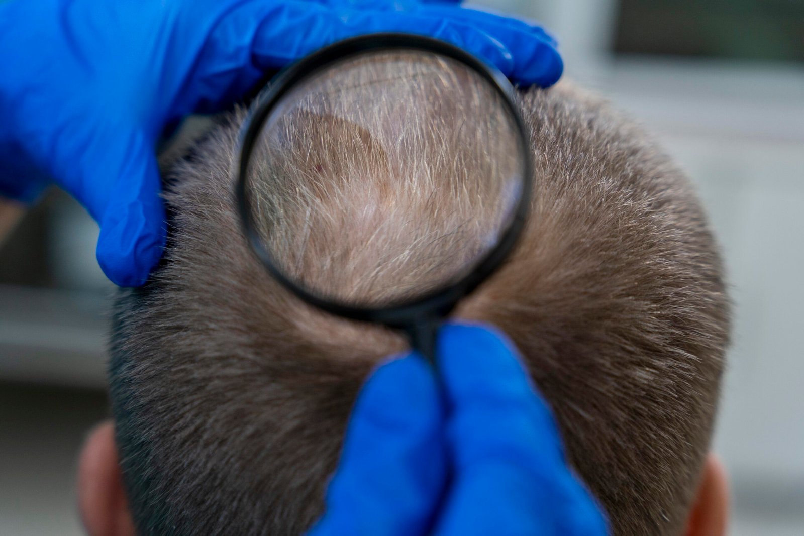 Paciente con alopecia mostrando resultados de nuevo tratamiento capilar experimental